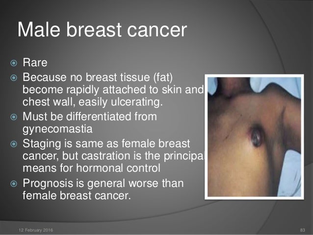 gynecomastia breast cancer Women sex moves
